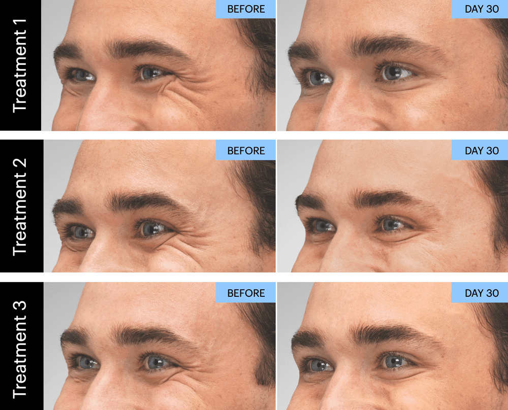 Botox before and after