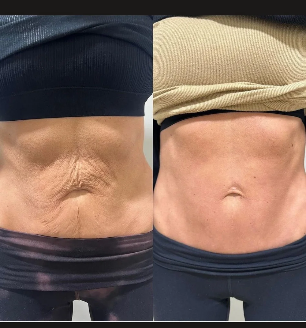Morpheus8 skin tightening before and after