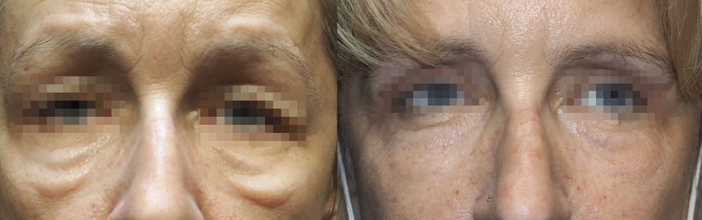 Morpheus8 skin tightening before and after