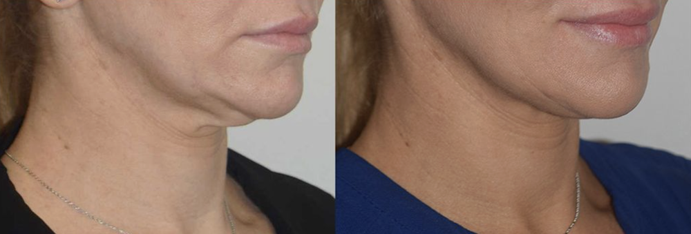 Morpheus8 skin tightening before and after