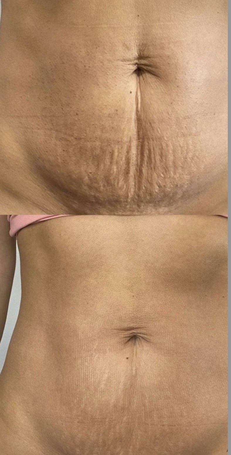 Morpheus8 skin tightening before and after