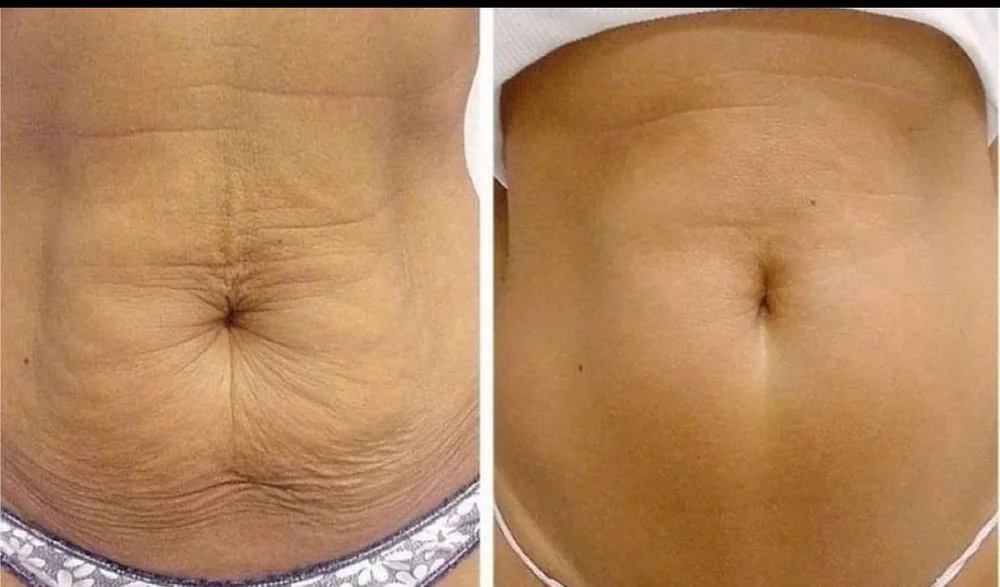 Morpheus8 skin tightening before and after