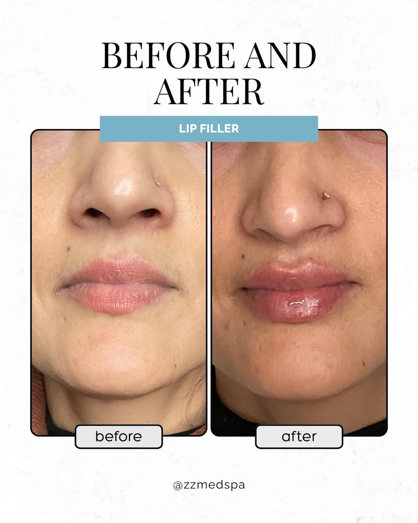 Soft, natural looking lips 💋

A little enhancement can make a big difference.
Lip filler can add soft volume and hydration while keeping things natural.

Performed by our licensed medical professionals.

📅 Book your consultation today at ZZ Med Spa