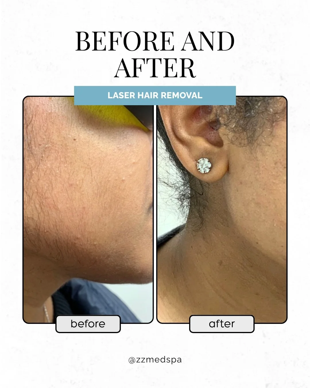 No more shaving or waxing 🪒

Laser hair removal helps reduce unwanted hair, ingrowns, razor burn, and the constant need to shave.
A long-term solution for smoother, low-maintenance skin.

Performed by licensed medical professionals.

✨Book your lase