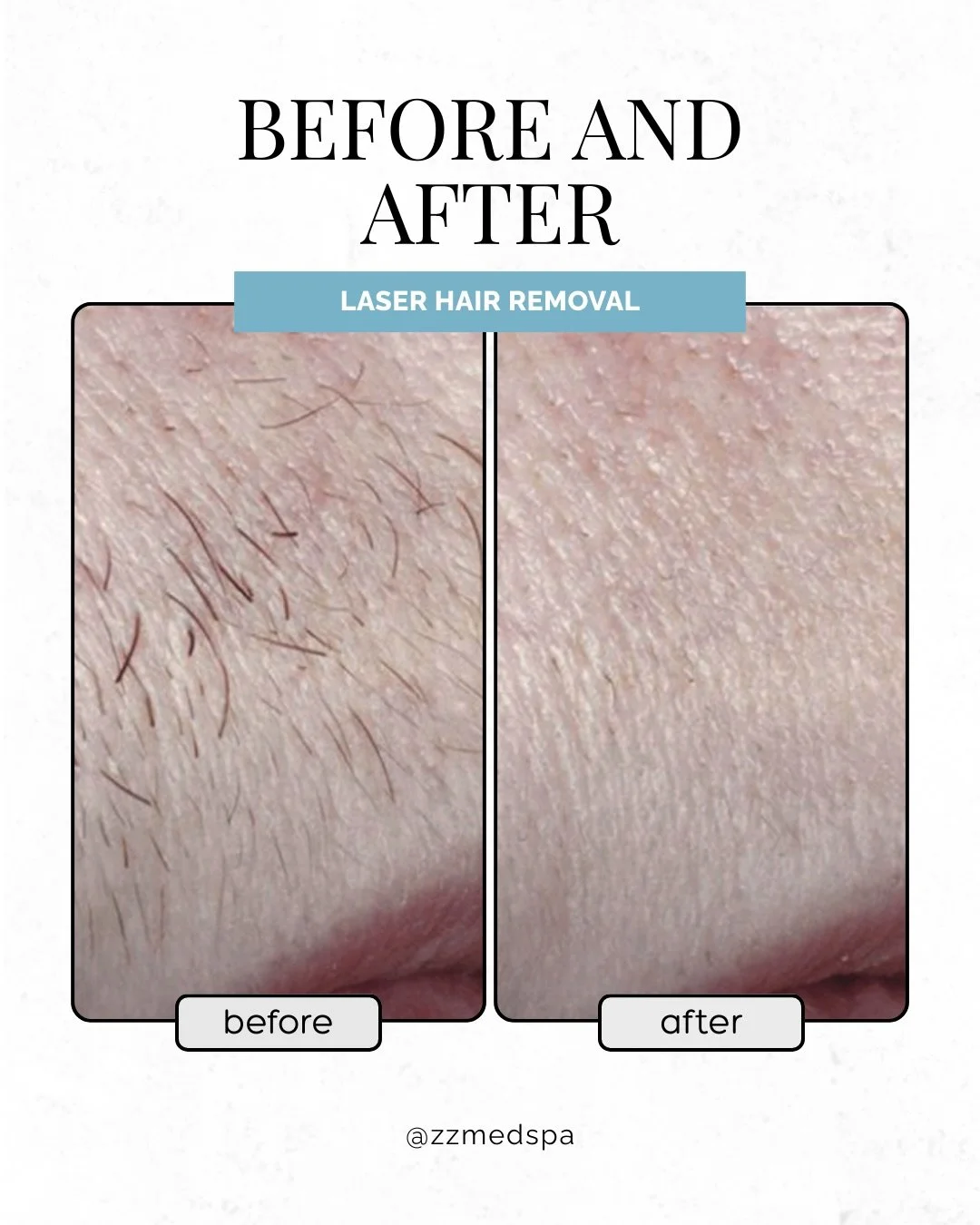 Ready to ditch unwanted hair before Valentine&rsquo;s Day? 😘

Laser hair removal helps reduce unwanted hair, ingrowns, razor burn, and constant shaving over time.

Perfect if you&rsquo;re looking for smoother, low-maintenance skin.

📆 Book your app