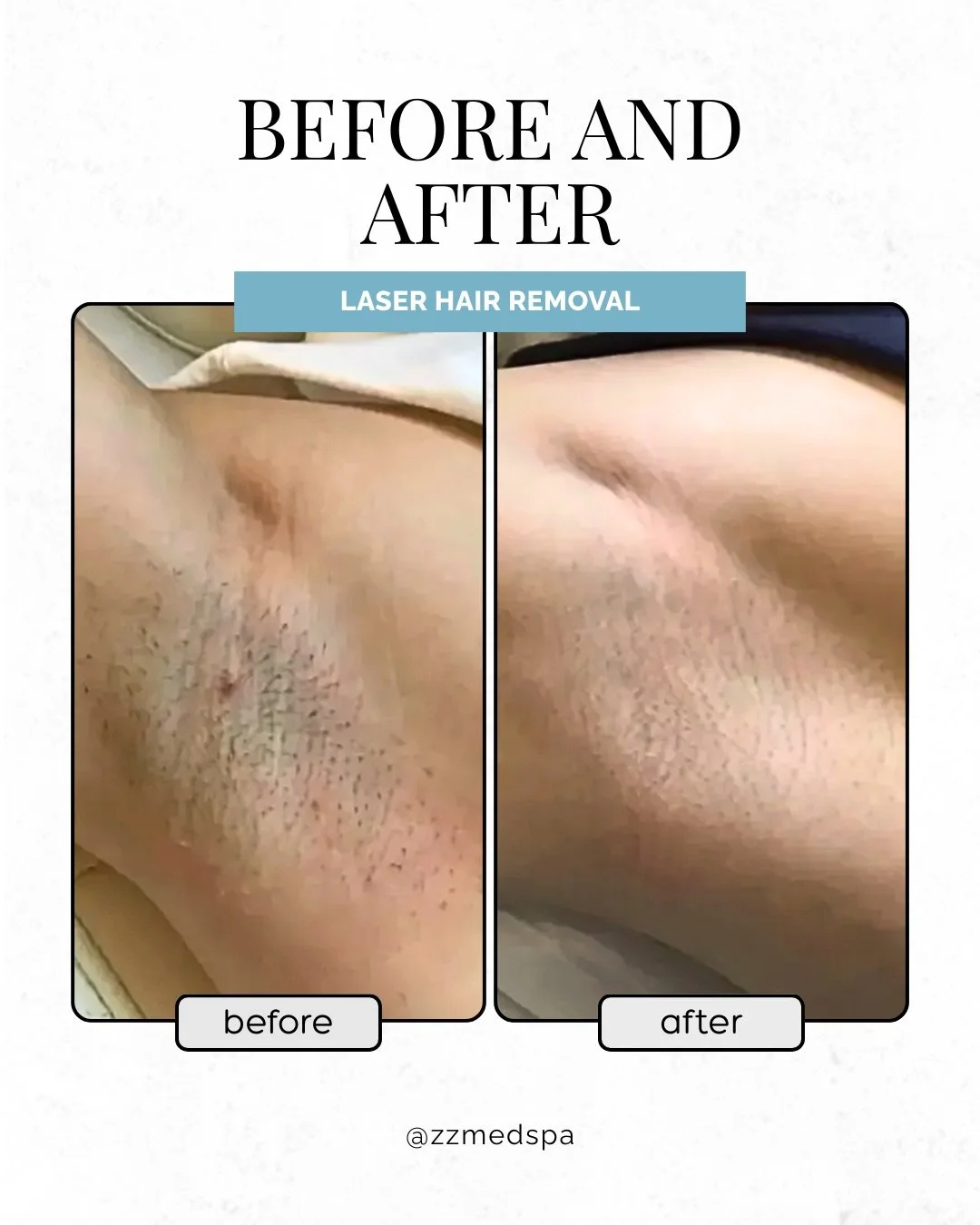 If shaving feels like a full-time job&hellip;

Laser hair removal is a long-term solution for unwanted hair and fast regrowth.
Less shaving, fewer ingrowns, smoother skin ✨

🔗 Book your visit with us via link in bio

#laserhairremoval #nyc #hairremo
