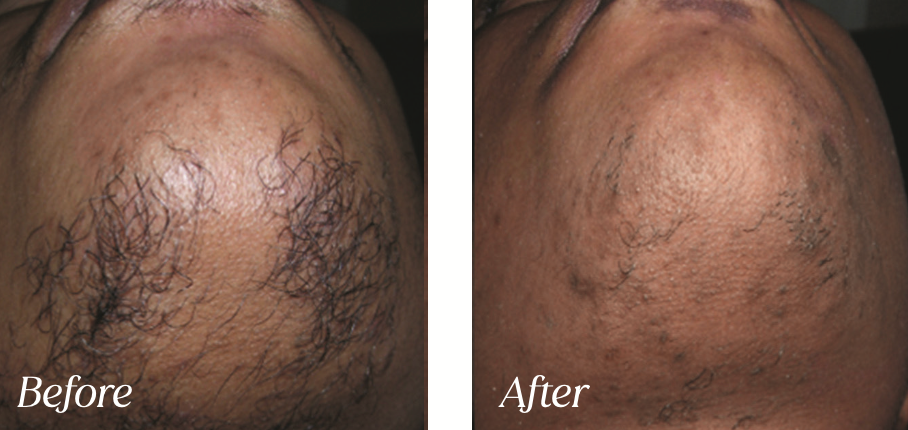 Laser hair removal before and after