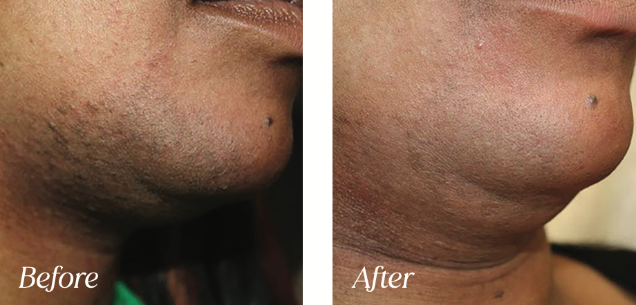 Laser hair removal before and after