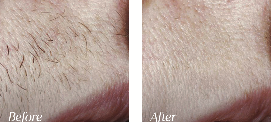 Laser hair removal before and after