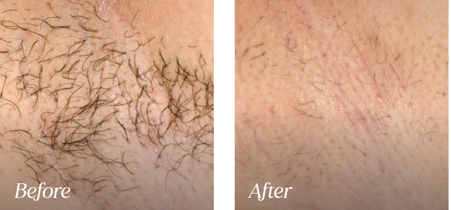Laser hair removal before and after