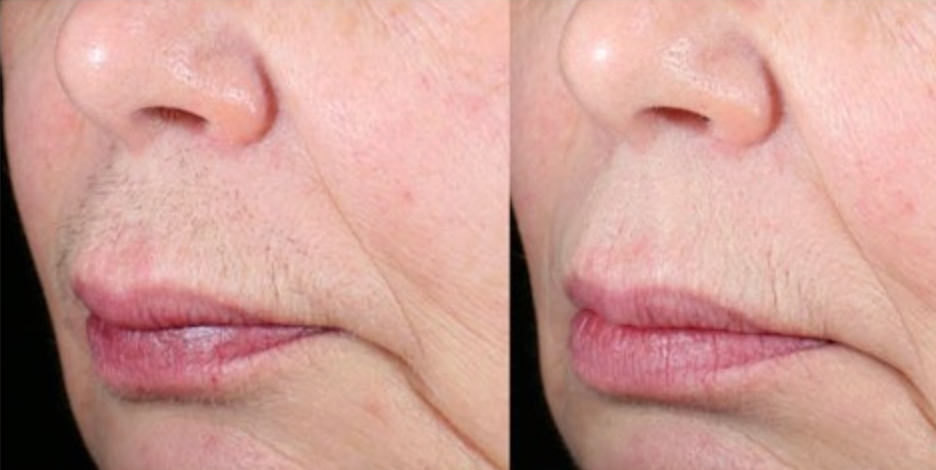 Laser hair removal before and after