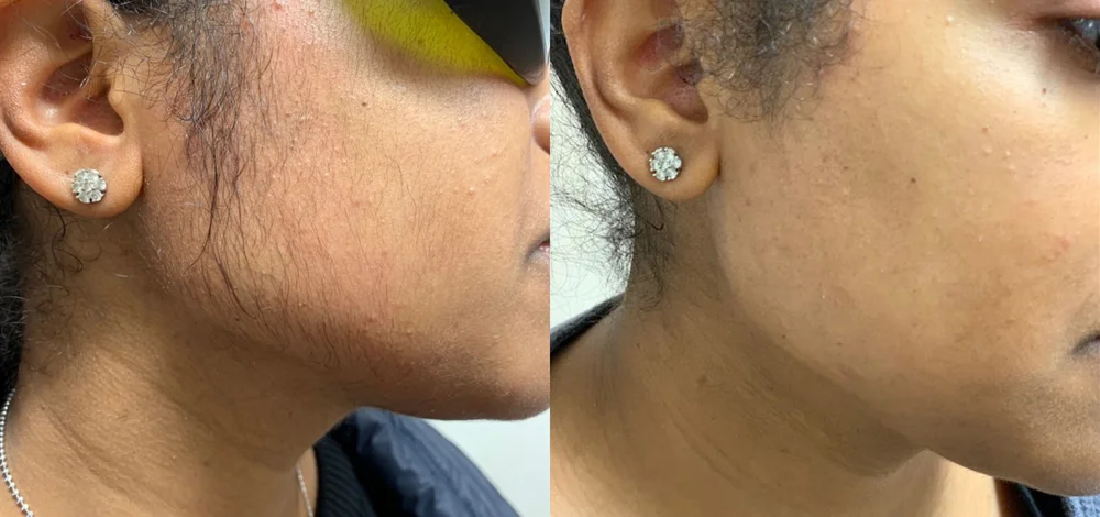 Laser hair removal before and after