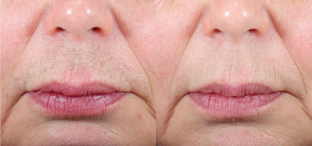 Laser hair removal before and after