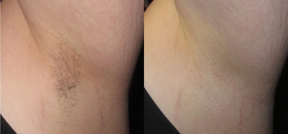 Laser hair removal before and after