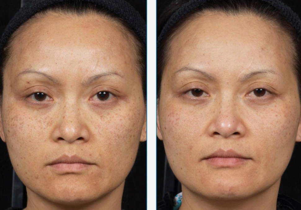 Clear and Brilliant facial before and after