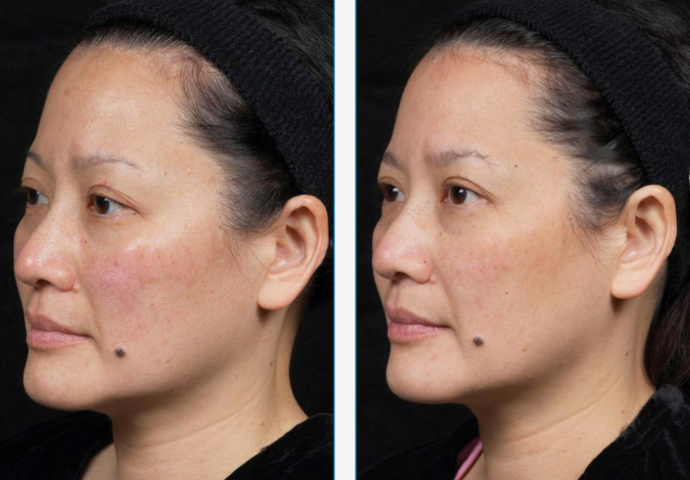 Clear and Brilliant facial before and after