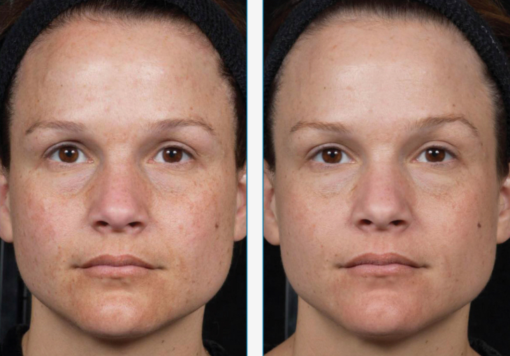 Clear and Brilliant facial before and after