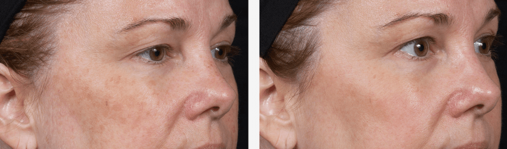 Clear and Brilliant facial before and after