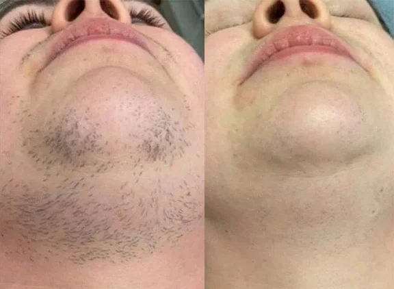 Laser Hair Removal Before and After 7.jpg