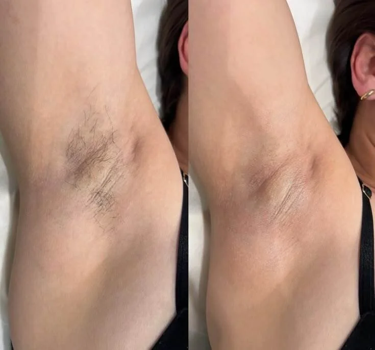 Laser Hair Removal Before and After 2.jpeg