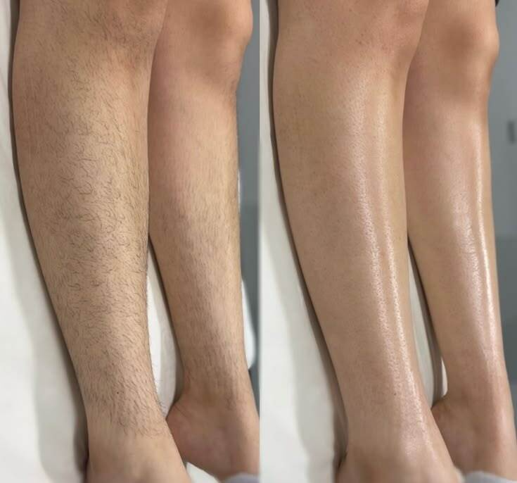 Laser Hair Removal Before and After 3.png