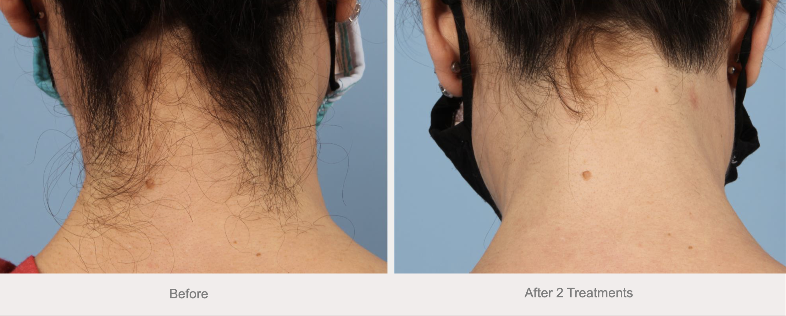 Laser Hair Removal Before and After 10.png