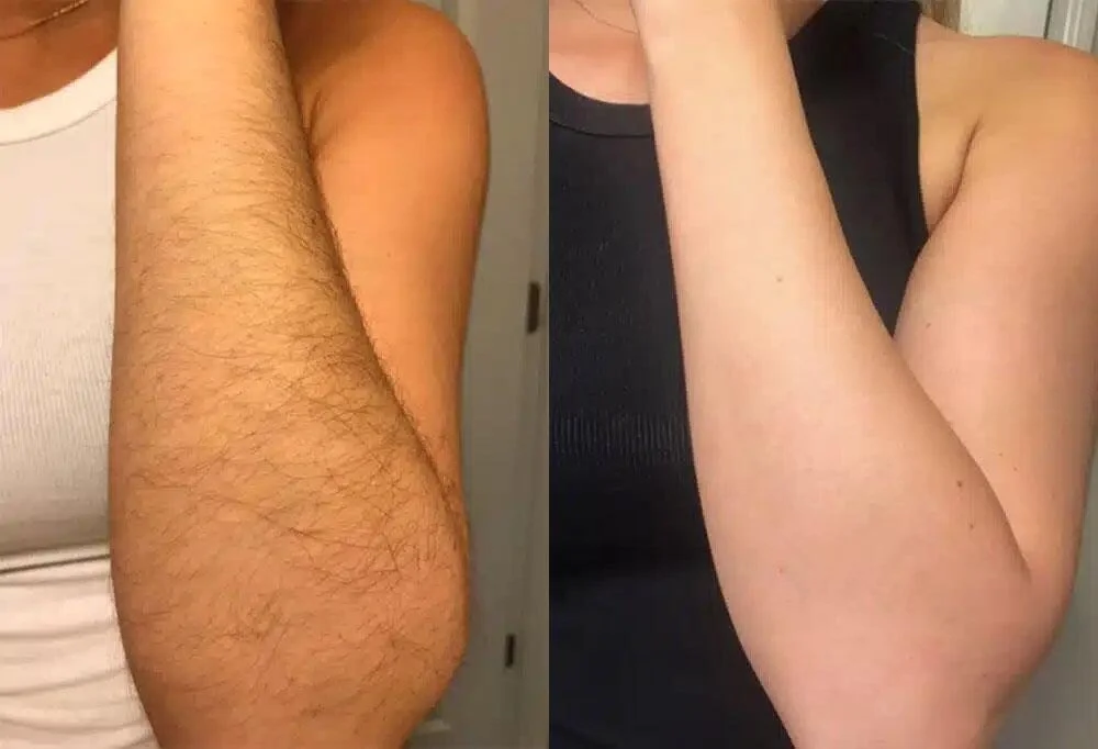 Laser Hair Removal Before and After 5.jpg
