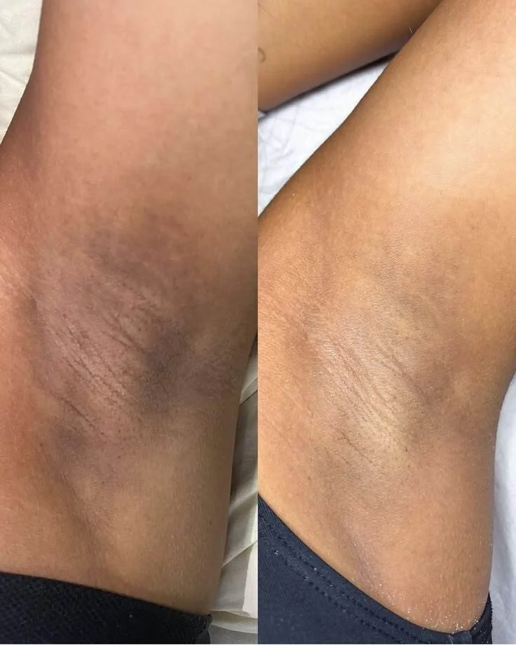 Laser Hair Removal Before and After 9.jpeg