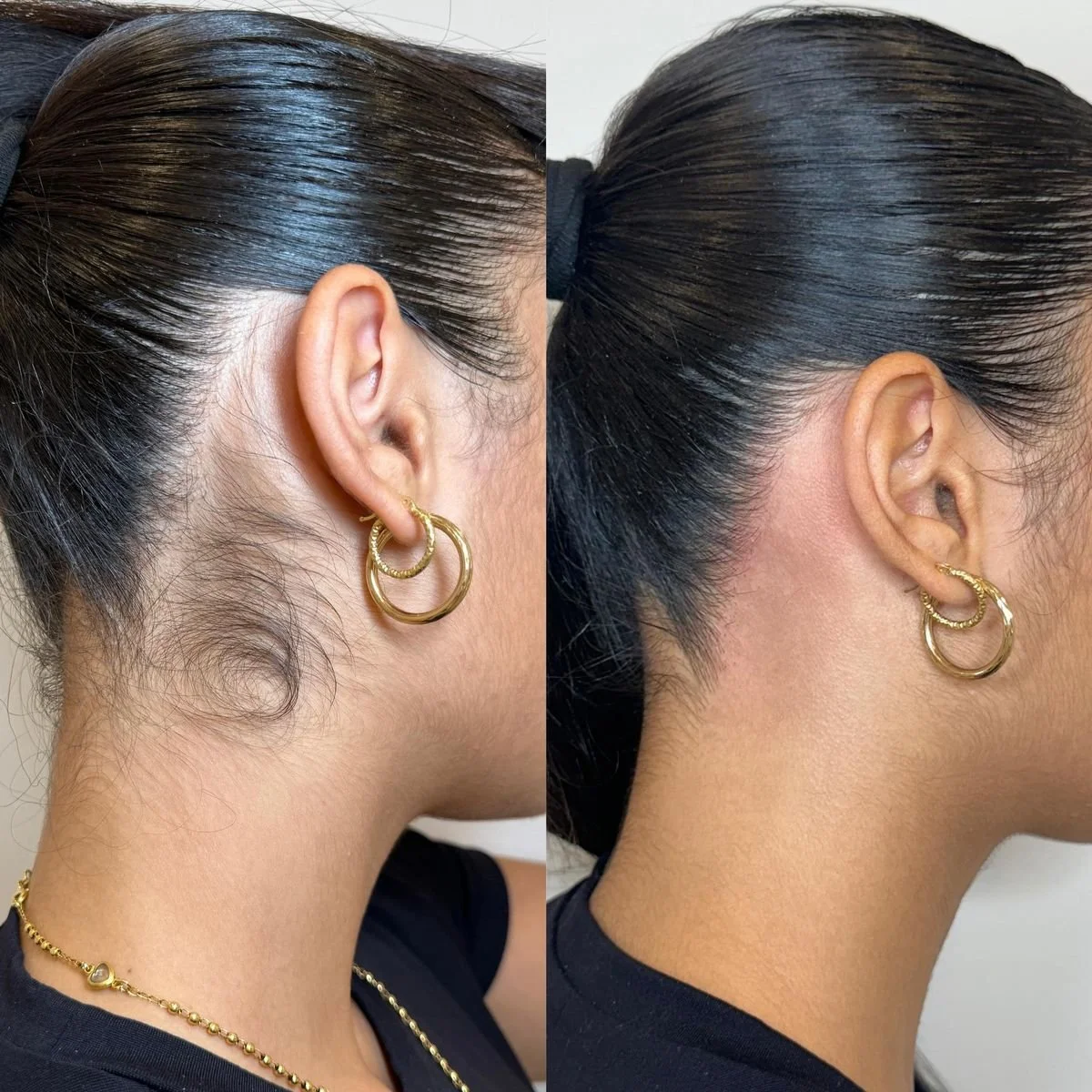 Laser Hair Removal Before and After 6.jpg