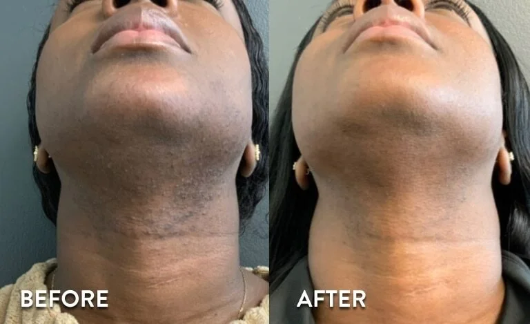 Laser Hair Removal Before and After 4.jpg