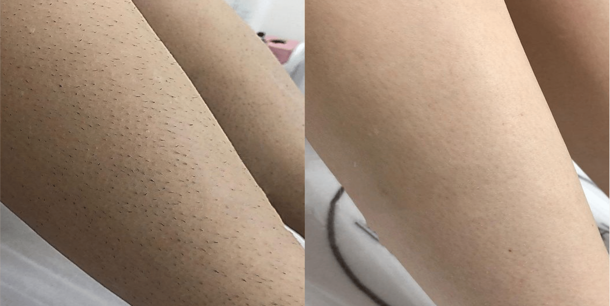 Laser Hair Removal Before and After 1.png