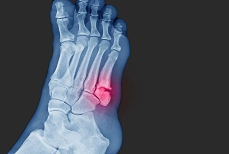 Avulsion Fracture: What Is an Avulsion Fracture and Can You Sue for It?