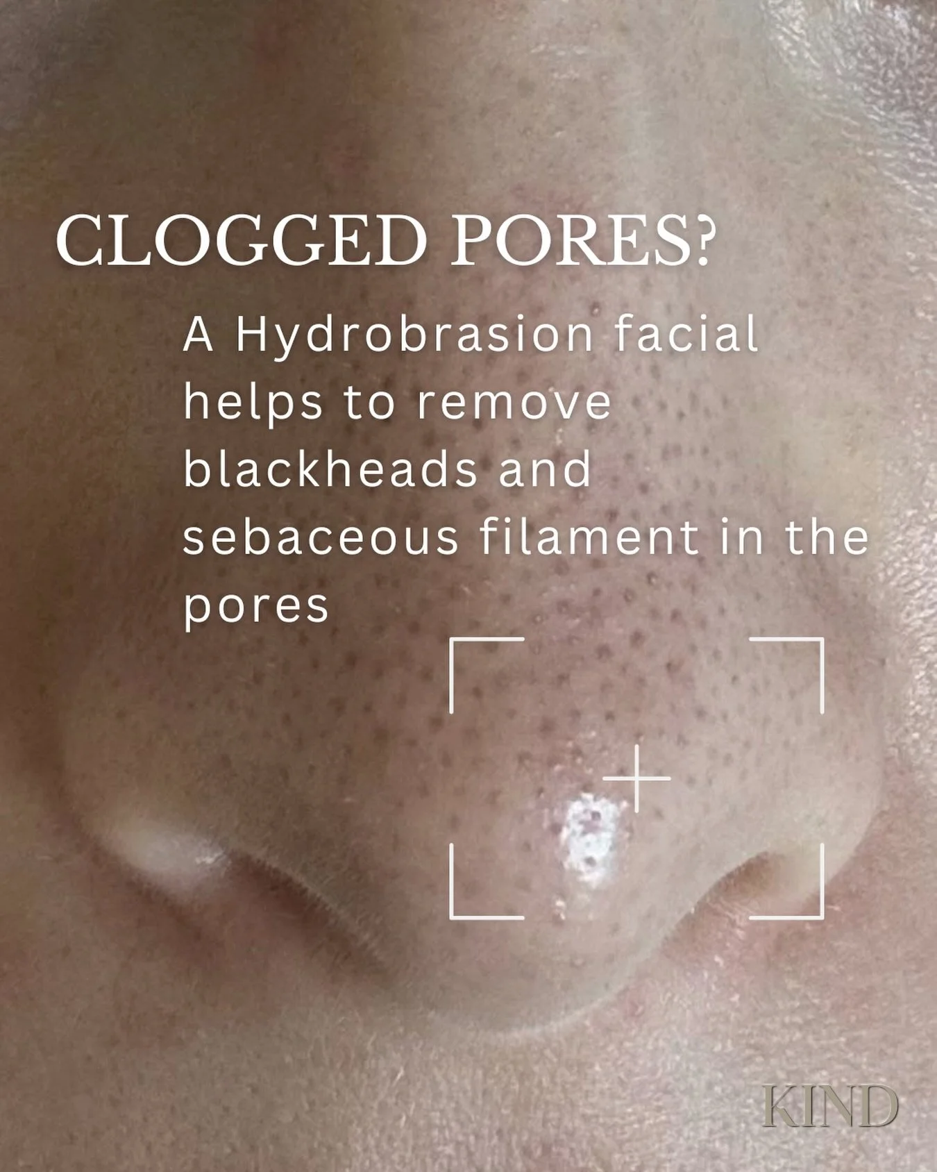 Are your pores clogged with sebaceous filament or blackheads? 

A Hydrobrasion facial works to flush out the debris clogging the pores, leaving the skin feel clean and smooth 

Save 20% on our Hydrobrasion Facials as apart of our Black Friday Sale (l
