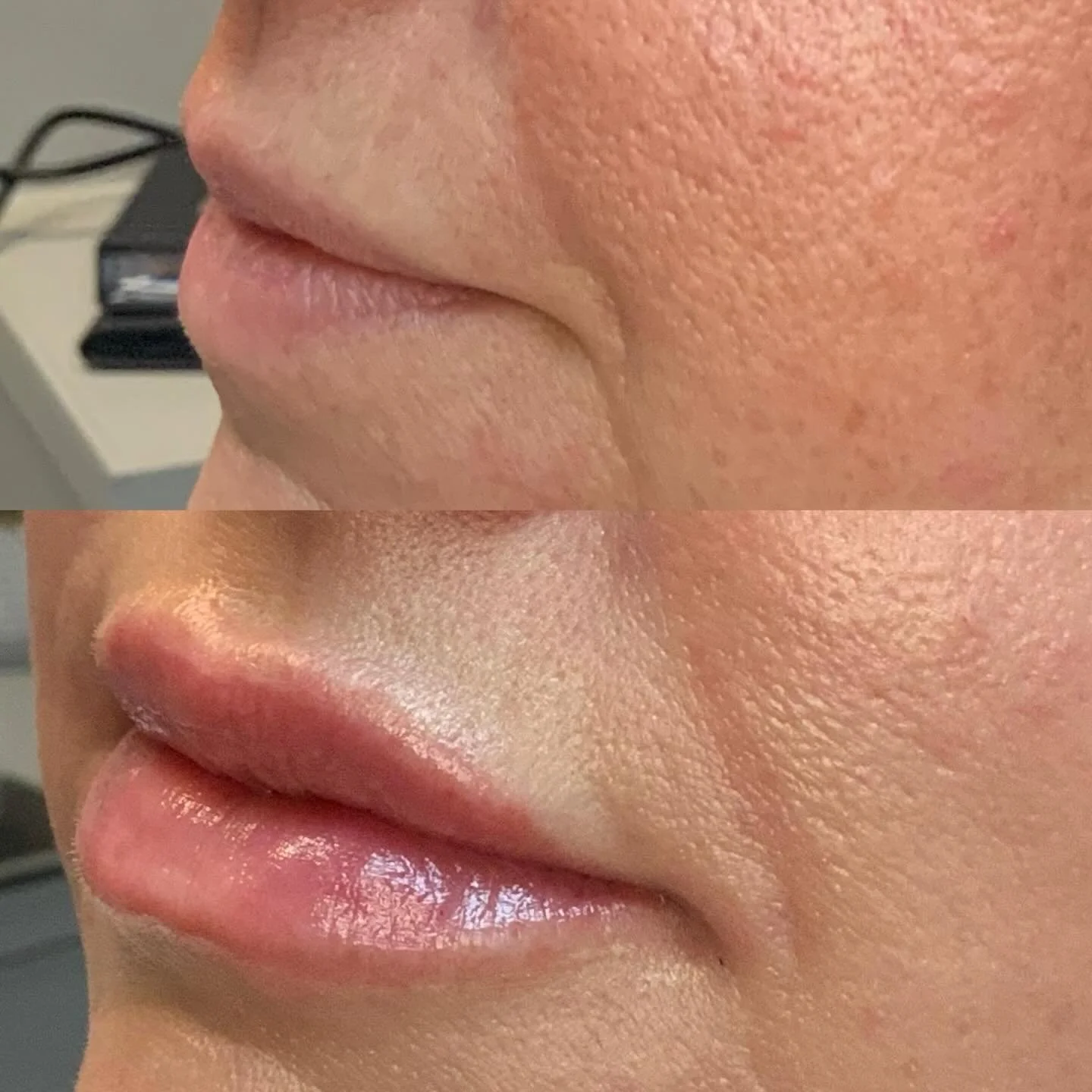 Freshly treated lips ✨
Soft, hydrated, and beautifully balanced&mdash;dermal filler is all about enhancing what&rsquo;s already yours. Subtle volume, smooth definition, and that fresh, confident glow (with results that continue to settle over the com