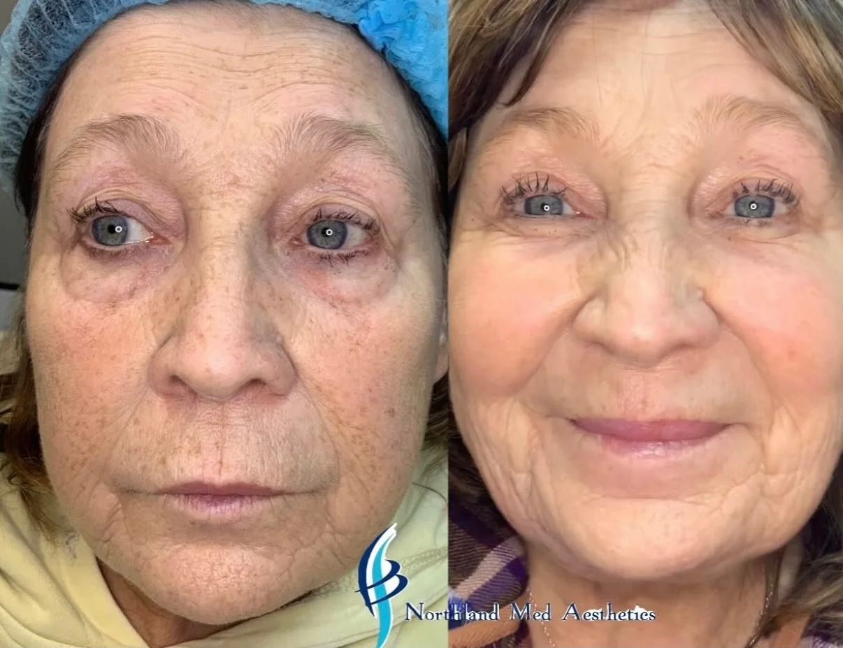 ✨ Broadband Light Laser Treatment ✨

This beautiful before/after says it all, her subtle smile 🥰

Broadband light laser treatment works by delivering precise pulses of light energy to gently target sun damage, redness, pigment, and uneven tone &mdas