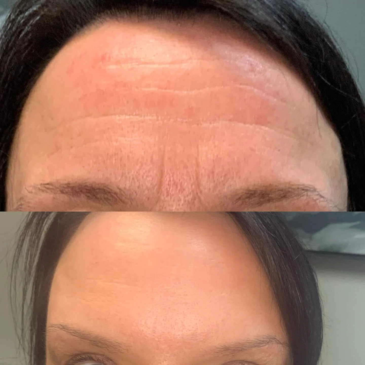 Forehead lines: dynamic vs. static

Neurotoxin works by relaxing the muscles that create dynamic lines&mdash;the wrinkles that form when we raise our brows or make expressions.

I always explain to patients that while this treatment is excellent for 
