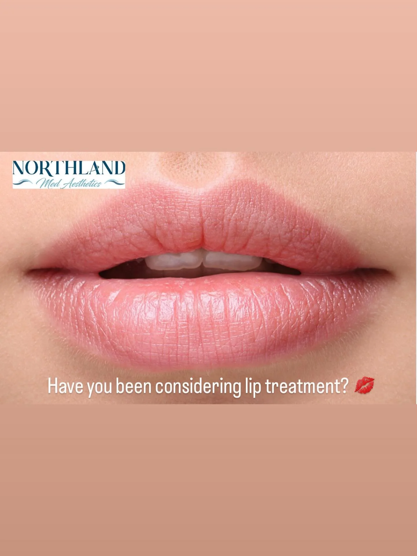 April lips 💋💙

We just sent out an email about a HUGE filler promo this month 👀

If you&rsquo;ve been thinking about lips (or a subtle lower face refresh)&hellip; this is your sign.

Limited availability&mdash;April only or while promo lasts.