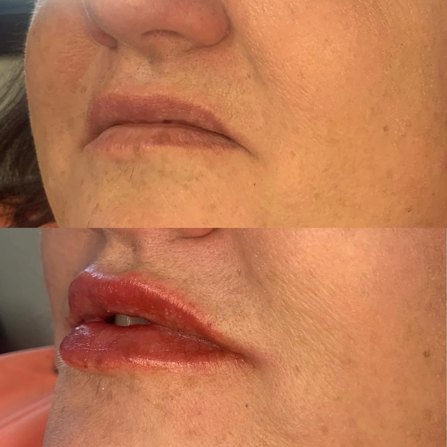 Subtle, refreshed, and beautifully balanced 💋

Lip rejuvenation isn&rsquo;t about overfilling&mdash;it&rsquo;s about restoring hydration, soft volume, and natural shape. A little support goes a long way in creating a smoother, more youthful appearan