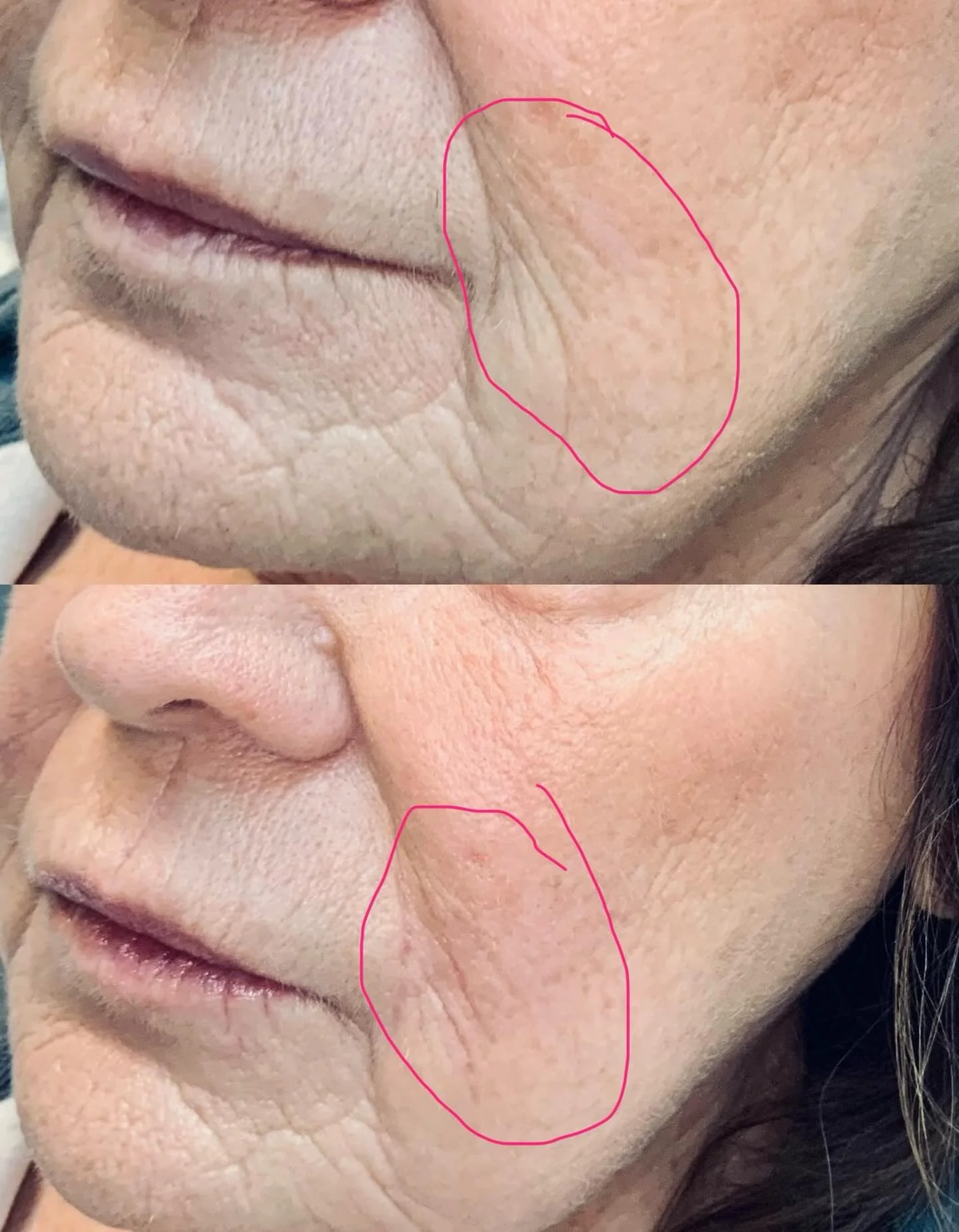 What can dermal filler really do?

Starting here&mdash;one syringe used to soften these superficial lines and restore support (not just lines).

Immediately after: smoother, more refreshed, still natural.