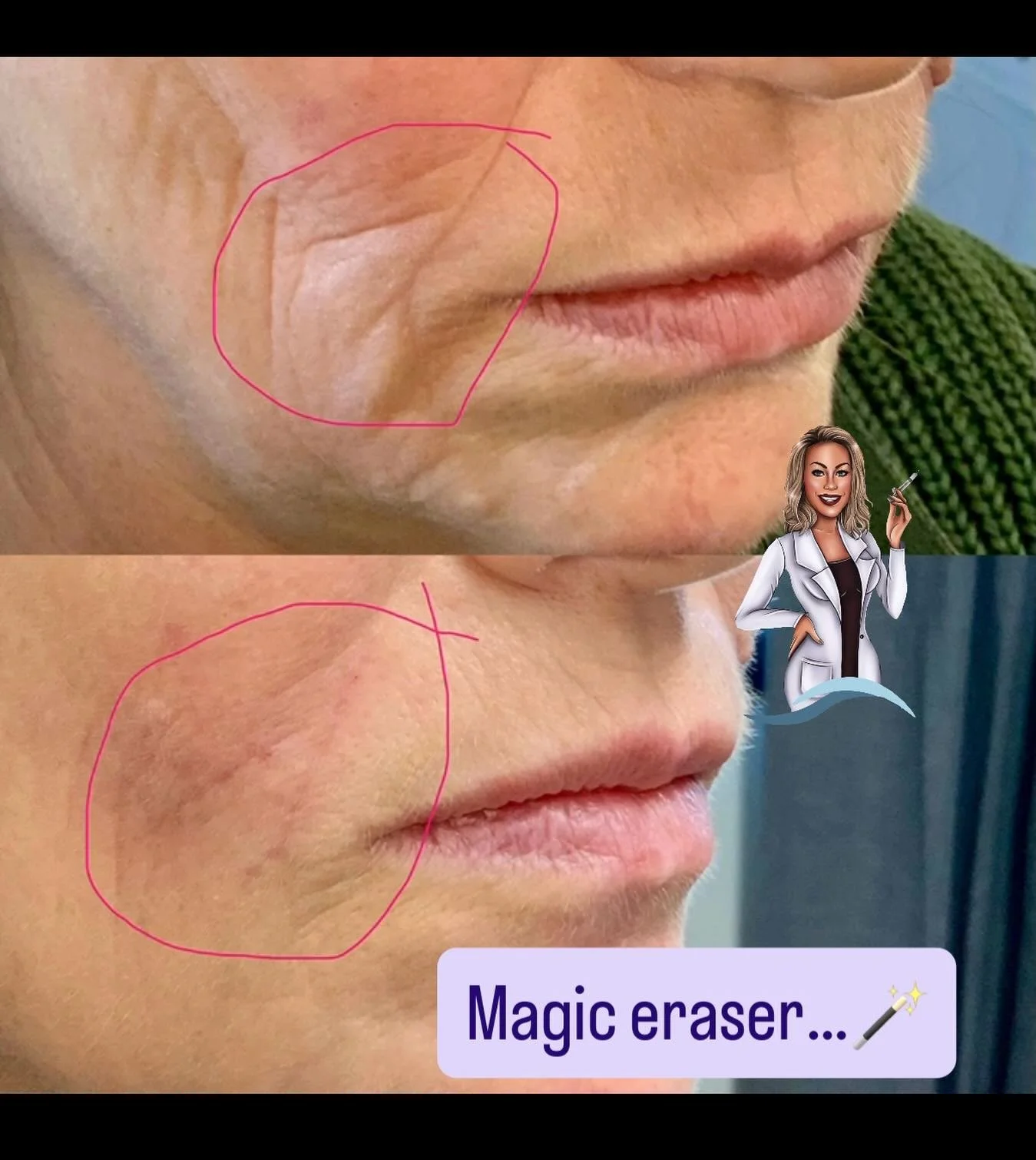 A little softening here can make a big difference ✨

Those etched lines don&rsquo;t need to define the whole face&mdash;just a touch of strategic treatment can smooth, support, and refresh while still looking completely natural.

Call it subtle&helli