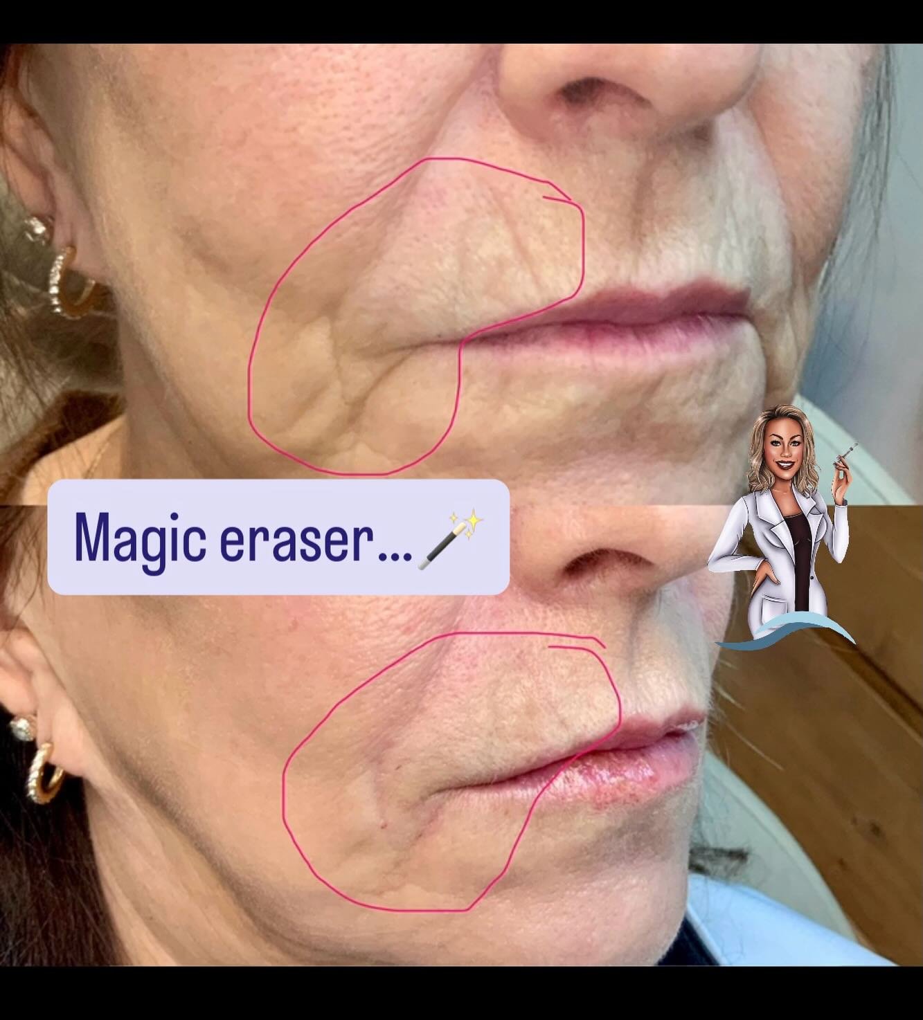 Oops&hellip; I did it again 😏✨

Softened the lines, restored a little support, and kept everything looking like her&mdash;just refreshed.

No overfilling. No overdoing it.
Just thoughtful, tailored treatment where it matters most.

Your not-so-secre