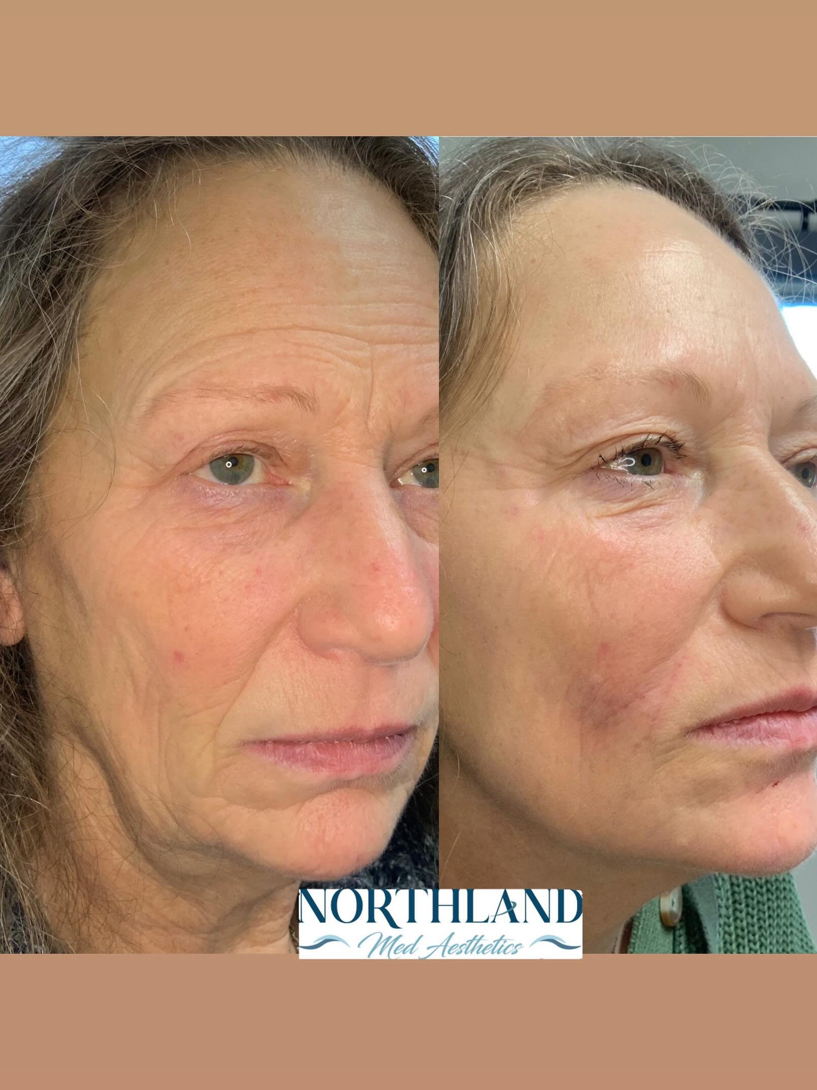 The Northland Med Aesthetics approach. This wasn&rsquo;t one treatment. It was a plan.

Over 5 months we focused on:
&bull; Building a strong skincare foundation
&bull; Two advanced CO₂ resurfacing treatments
&bull; Conservative, strategic injectable