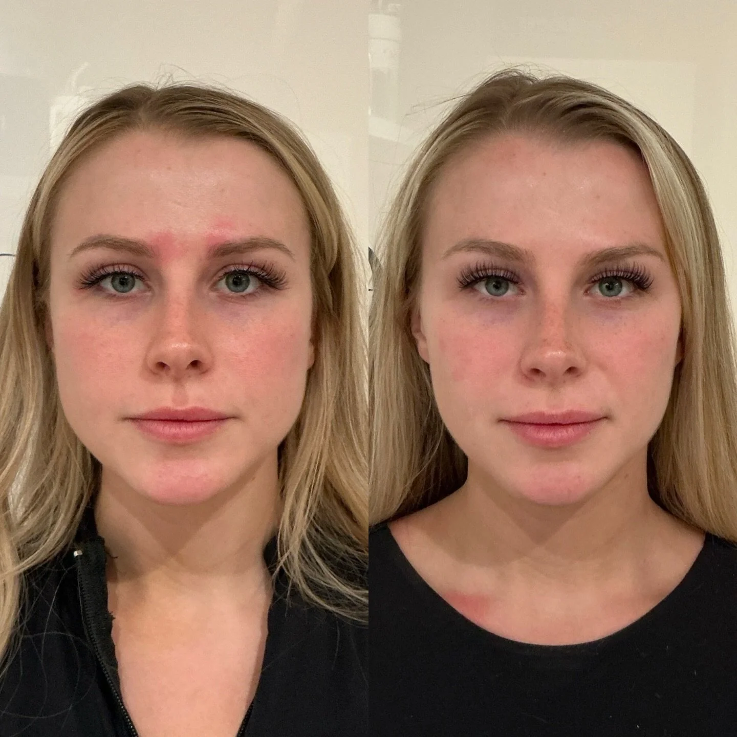 M A S S E T E R  T O X 💉

Masseter tox, a procedure involving the injection of botulin toxin into the masseter muscle, offers several benefits, particularly for individuals with conditions like bruxism (teeth grinding) or temporomandibular joint (TM