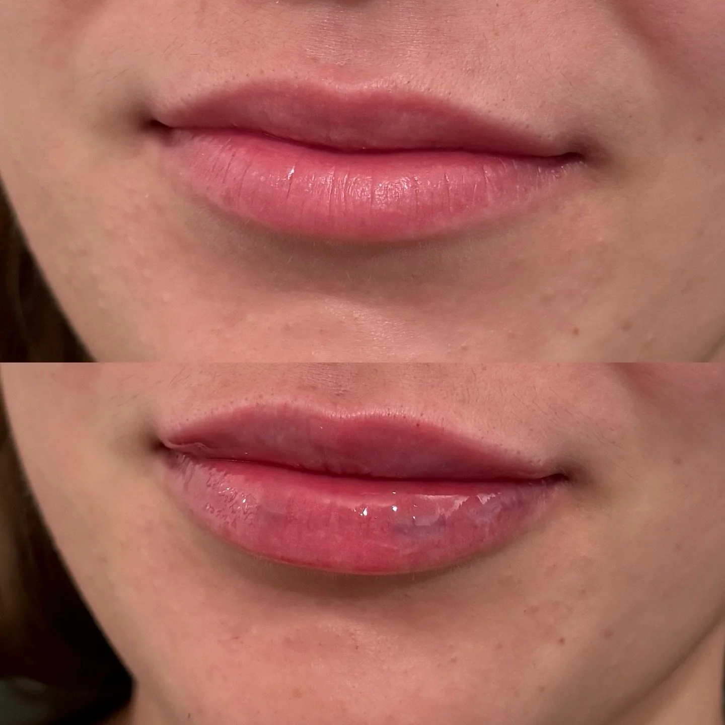 L I P  F I L L E R &amp;  B R U I S I N G 🤎 

Bruising after lip filler is 𝐜𝐨𝐦𝐩𝐥𝐞𝐭𝐞𝐥𝐲 𝐧𝐨𝐫𝐦𝐚𝐥 &amp; 𝐞𝐱𝐩𝐞𝐜𝐭𝐞𝐝. The lips are one of the most vascular areas of the face, meaning there are lots of tiny blood vessels just under the