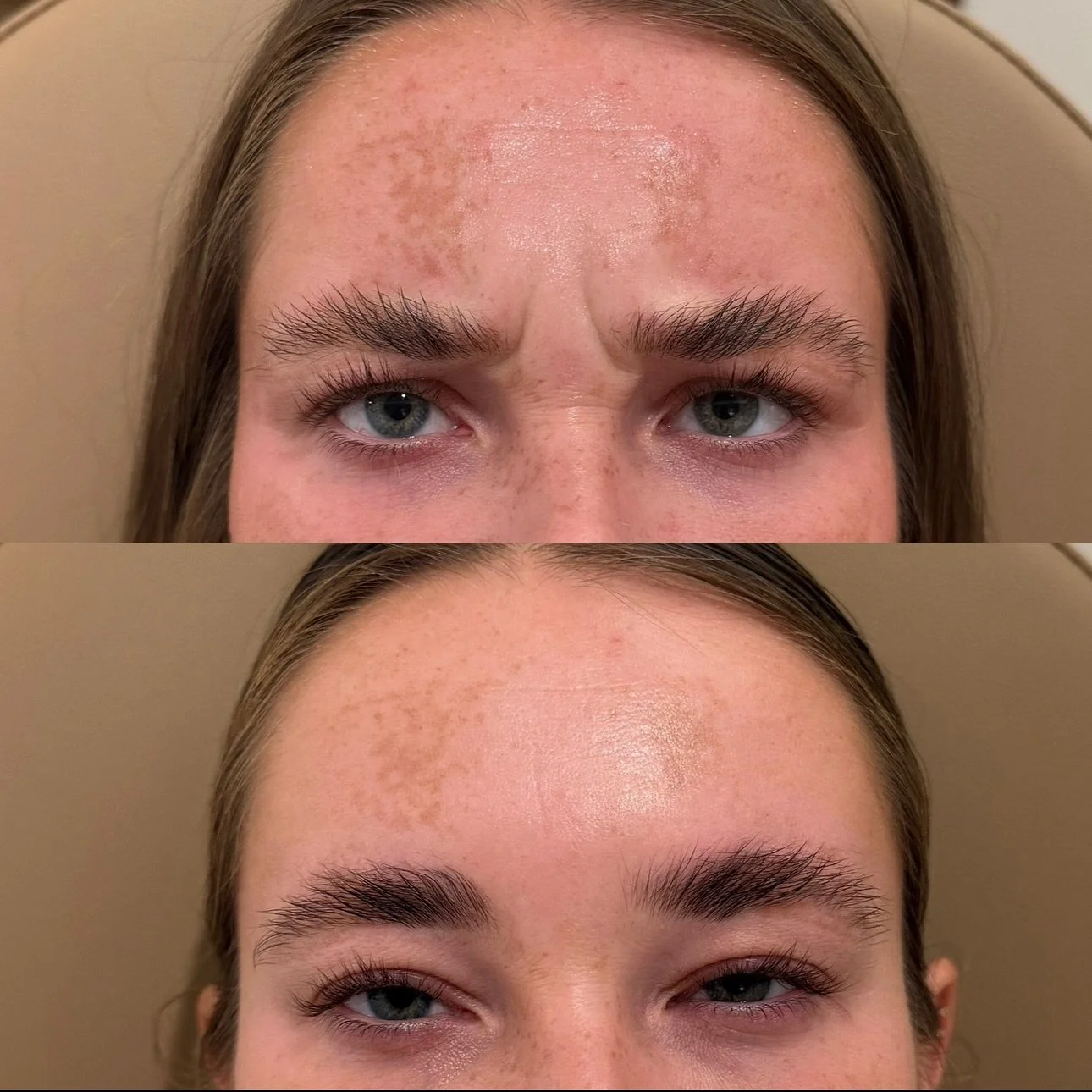 S T A T I C  V S.  D Y N A M I C  L I N E S 💉

Not all lines on the face are the same.

𝘋𝘺𝘯𝘢𝘮𝘪𝘤 lines appear with facial expression (like smiling or frowning) and fade when the face is at rest. 𝘚𝘵𝘢𝘵𝘪𝘤 lines linger even when the face is 