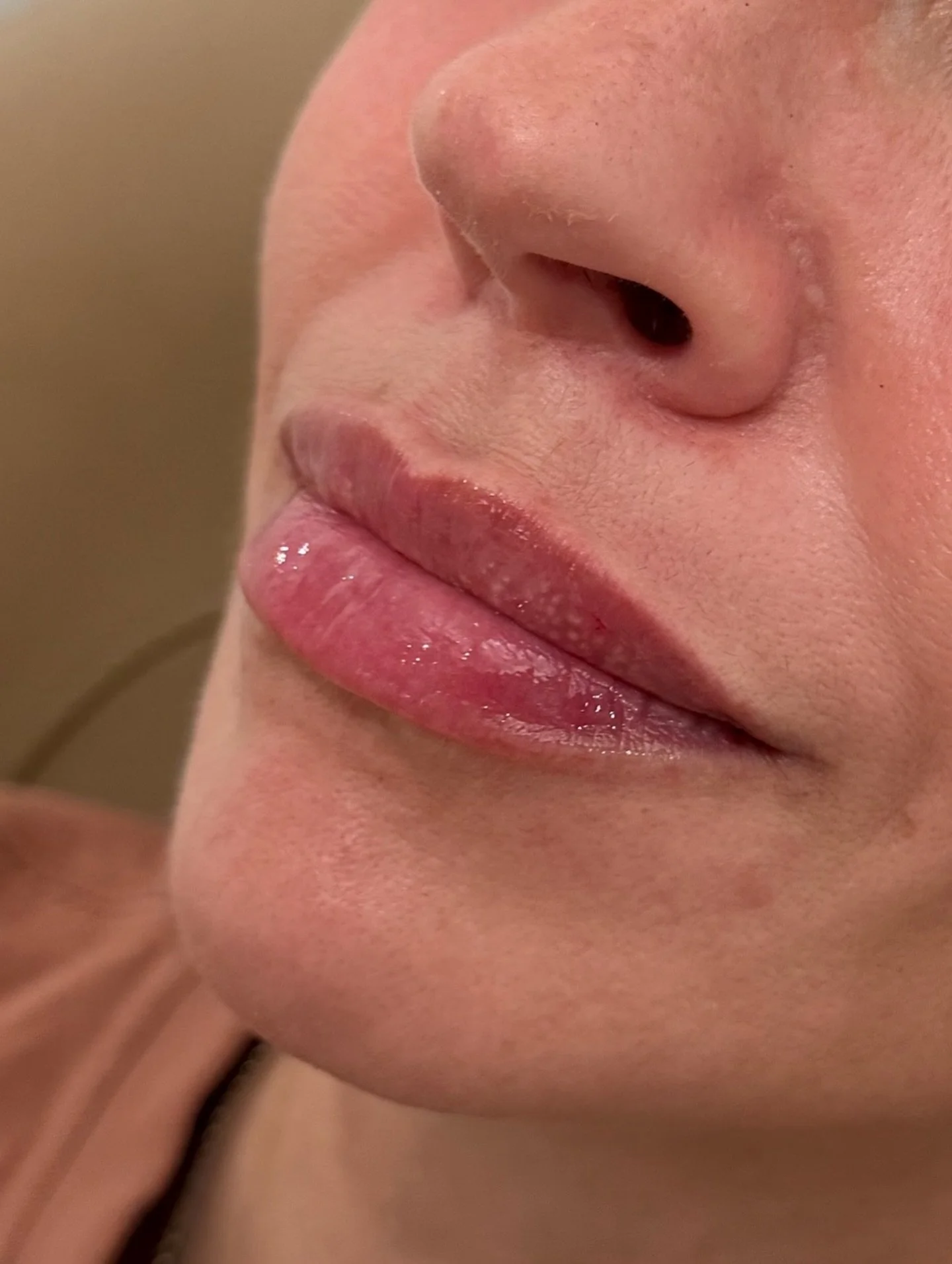 L I P  F I L L E R 🤎

Lip enhancement with hyaluronic acid dermal filler is a non-surgical way to add balance, volume &amp; elegance to your lips - all while preserving your natural harmony. 

Treatment Details:
&bull;𝐩𝐮𝐫𝐩𝐨𝐬𝐞: hyaluronic acid