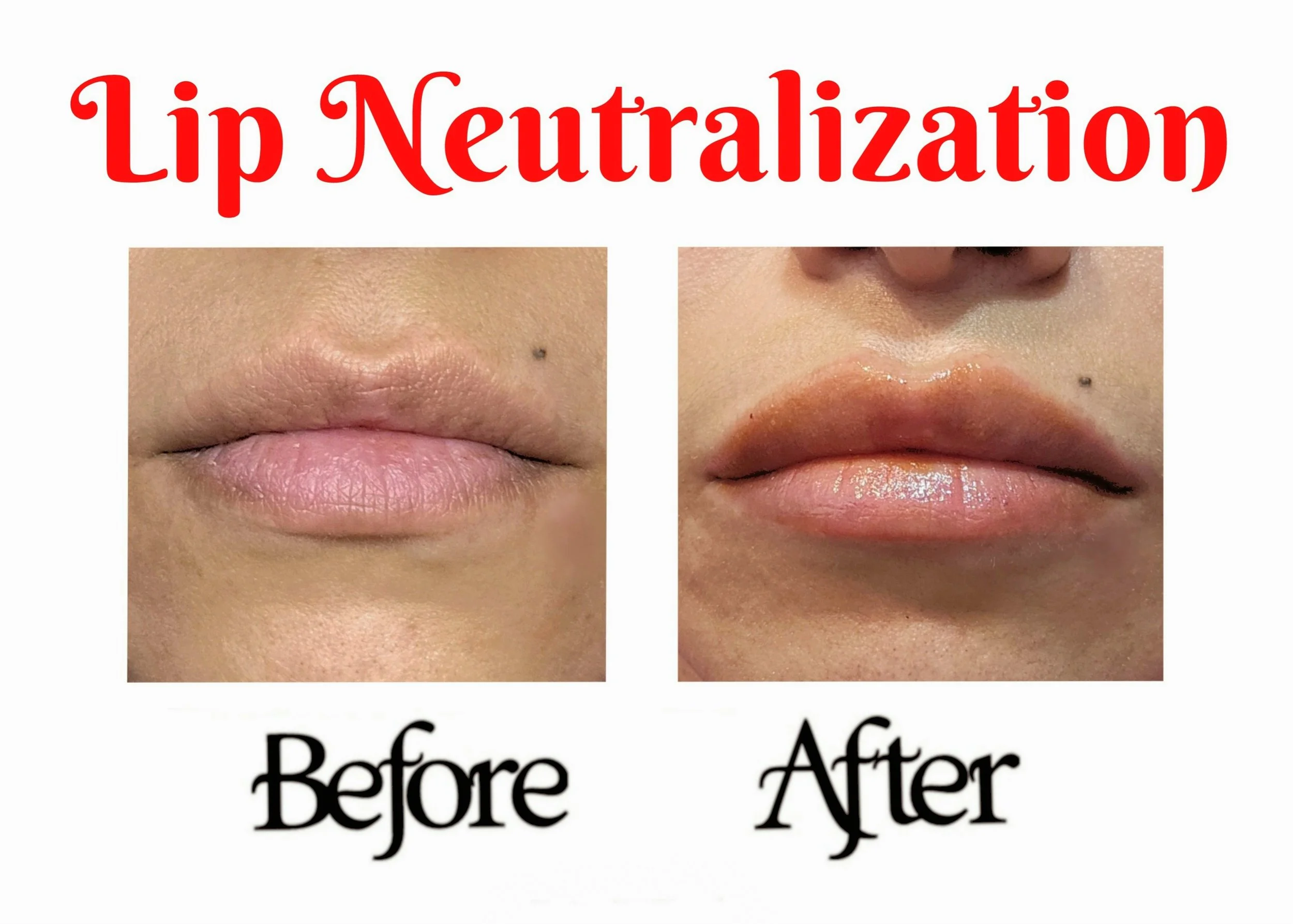 Lip neutralization 1.jpg