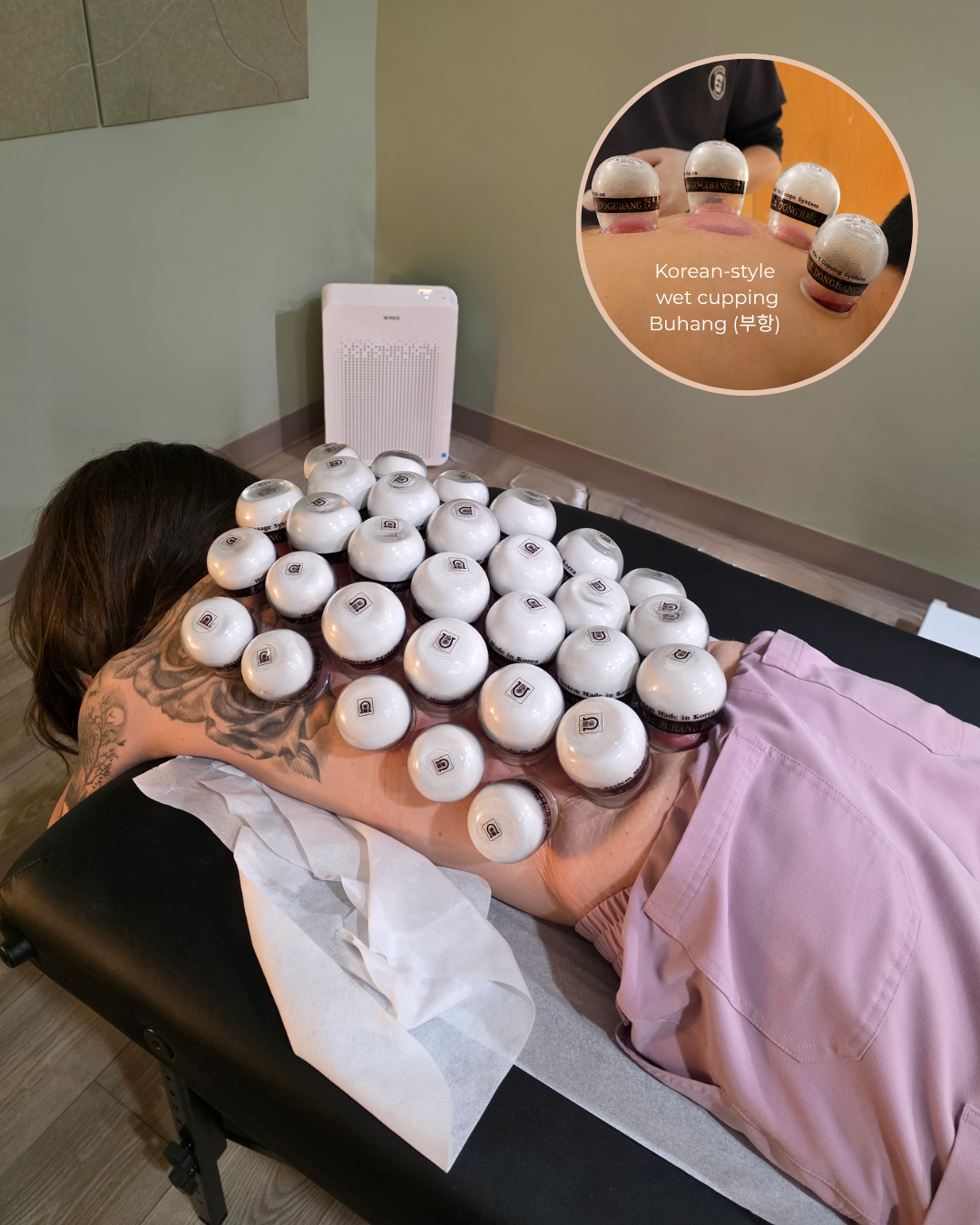 Medical Acupuncture / Cupping | Integrative Holistic Medicine in ...