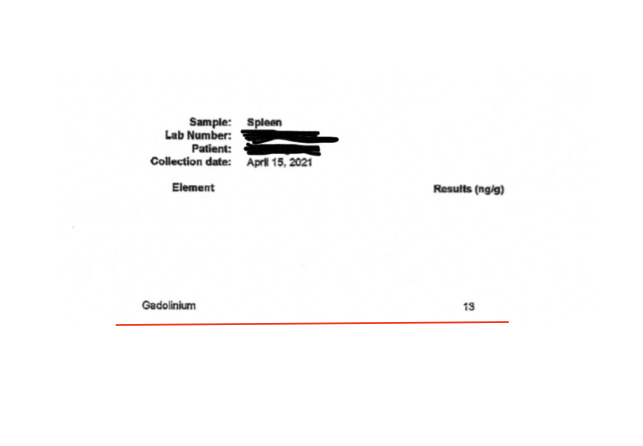 Laboratory report showing a spleen test result with a gadolinium level of 13 ng/g, dated April 15, 2021.