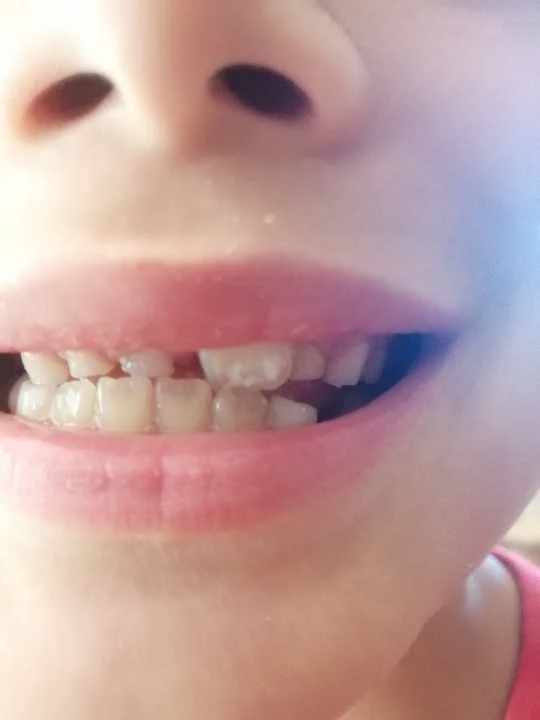 A close-up of a child's mouth showing misaligned and missing teeth.